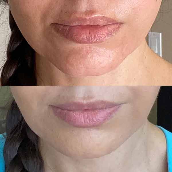 Chin-filler-acne-scarring