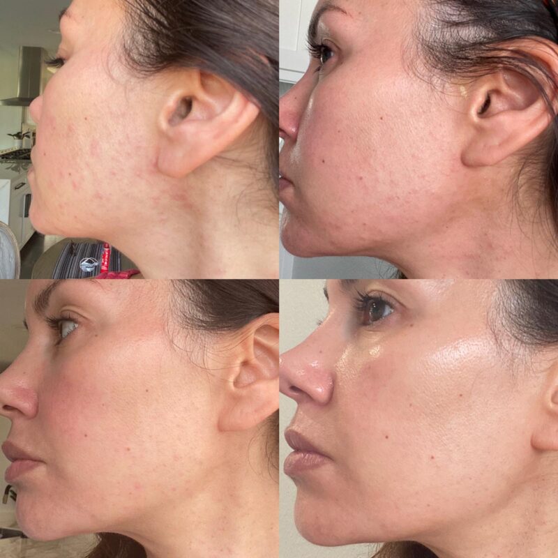 fungal-acne-before-and-afters