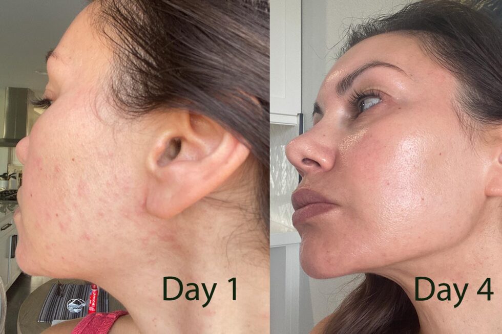 My Fungal Acne Treatment How To Get Rid Of Fungal Acne In One Week my-fungal-acne-treatment-how-to-get-rid-of-fungal-acne-in-one-week