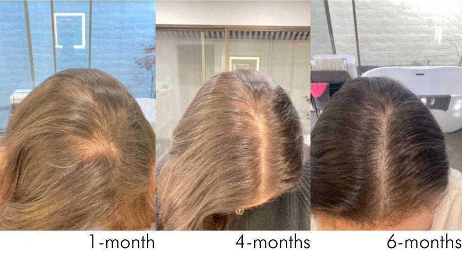 Hair Growth Over 6 Months