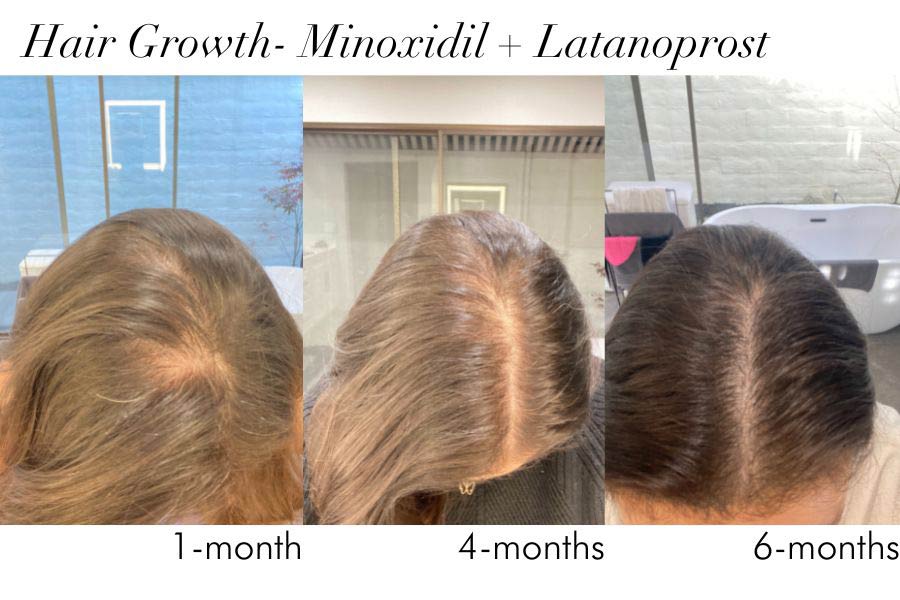 Hair Growth Over 6 Months